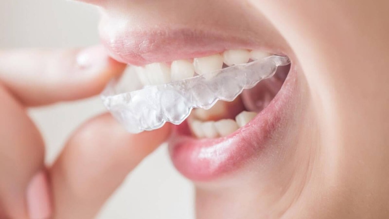 Елайнери Invisalign: інноваційний підхід до корекції прикусу та вирівнювання зубів