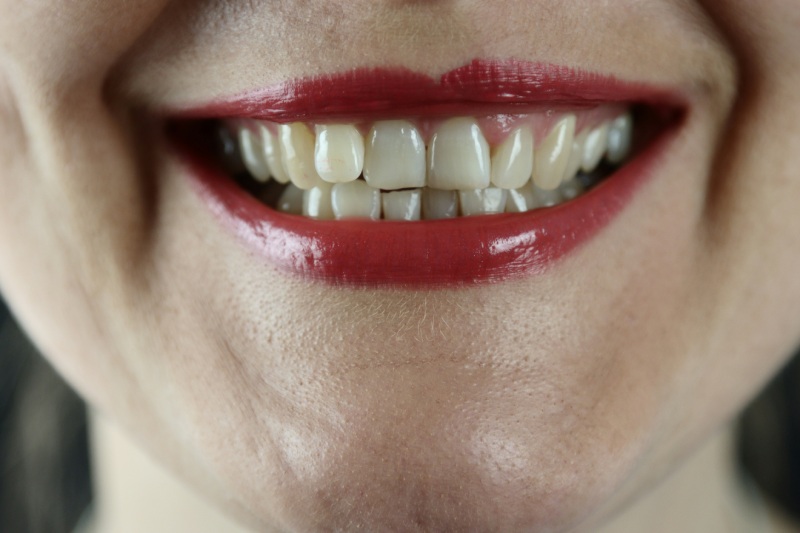 Чому з'являються тріщини на зубній емалі