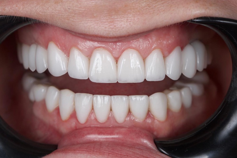 Композитні вініри чи керамічні – що обрати для ідеальної посмішки